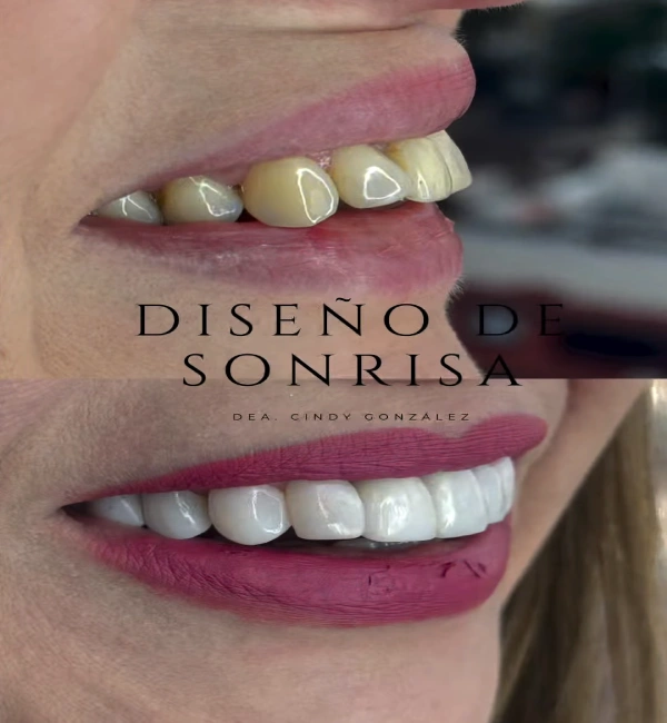 Estética-dental