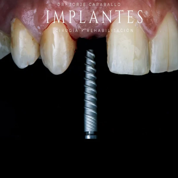 Implantología