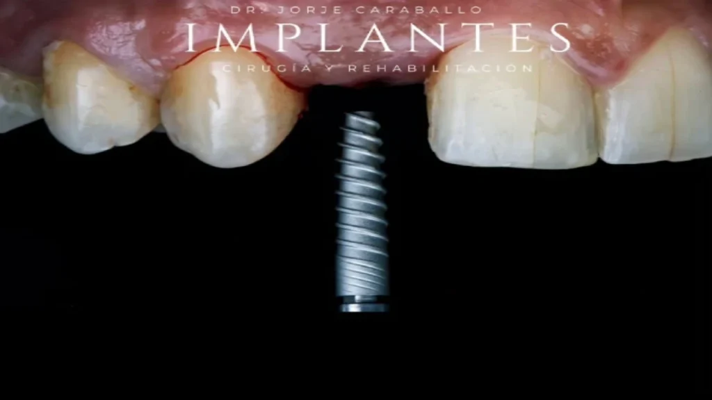 Implantes-dentales-en-Santiago