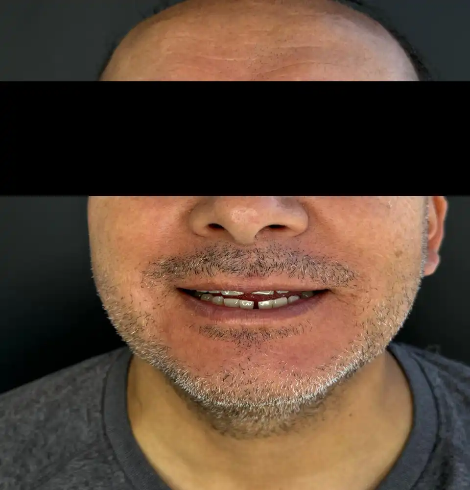 caso-de-diseño-de-sonrisa-antes-9