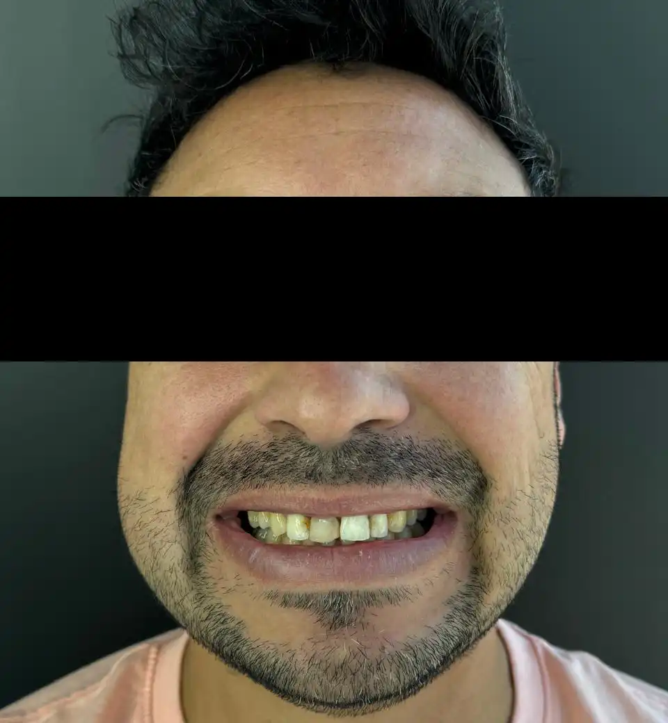 caso-de-diseño-de-sonrisa-antes-8