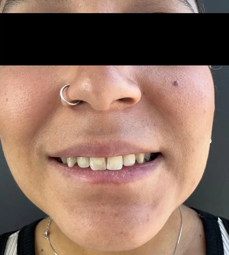 caso-de-diseño-de-sonrisa-antes-7