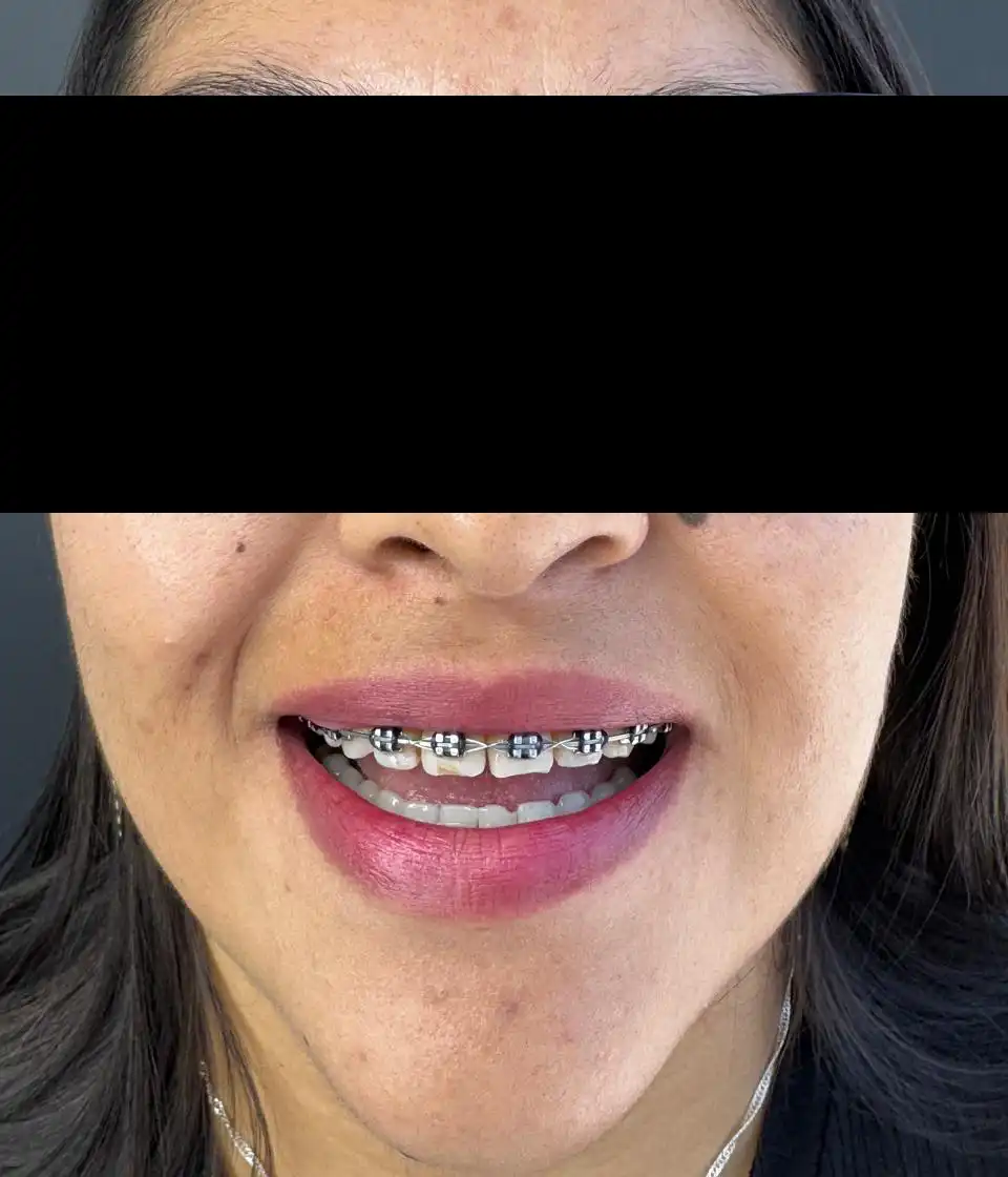 caso-de-diseño-de-sonrisa-antes-6