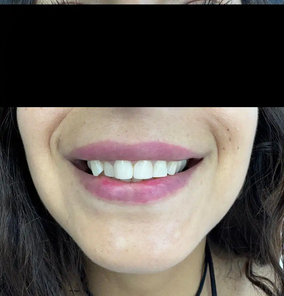 caso-de-diseño-de-sonrisa-antes-3