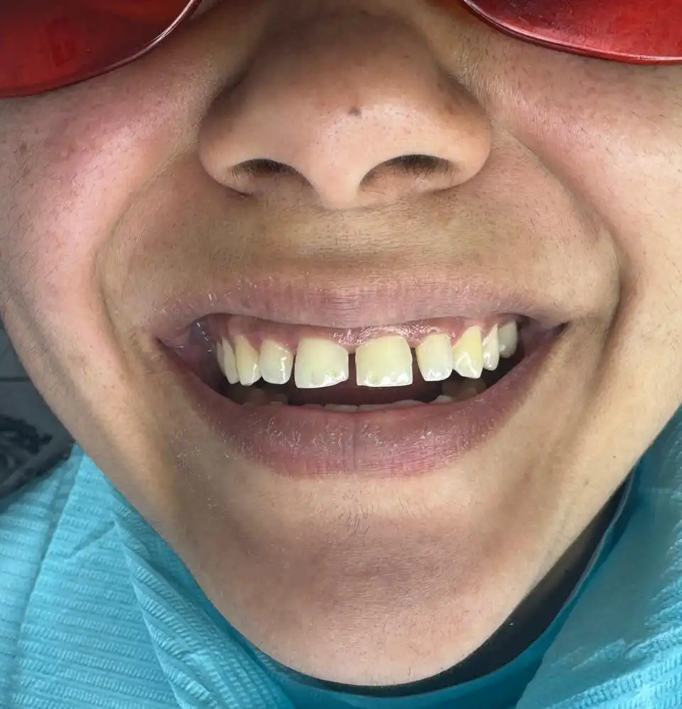 caso-de-diseño-de-sonrisa-antes-4