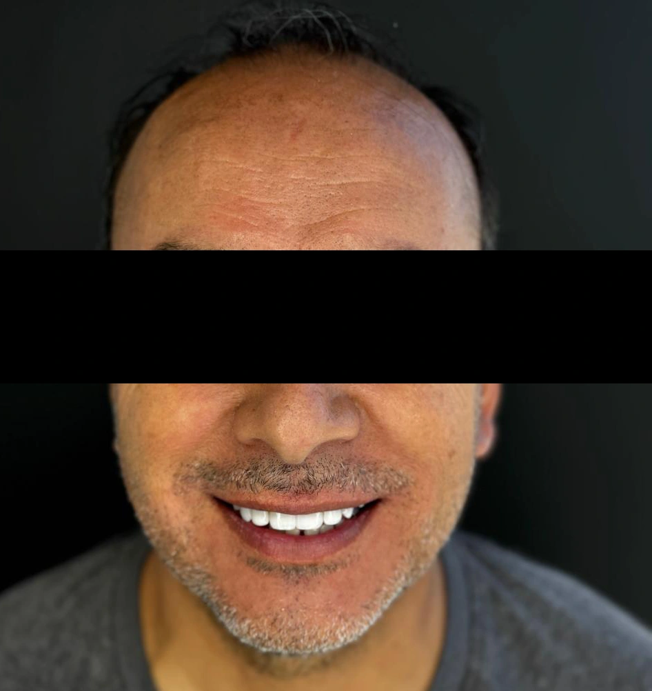 caso-de-diseño-de-sonrisa-despues-9