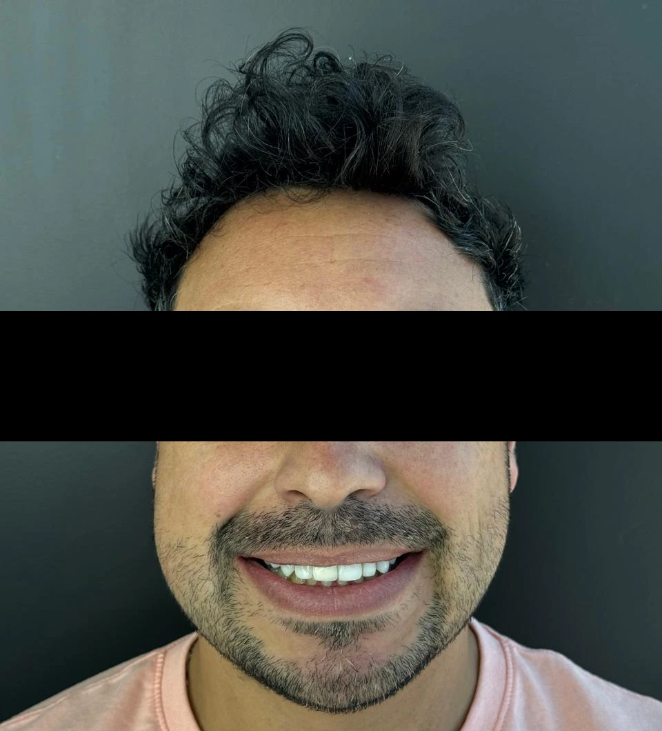 caso-de-diseño-de-sonrisa-despues-8
