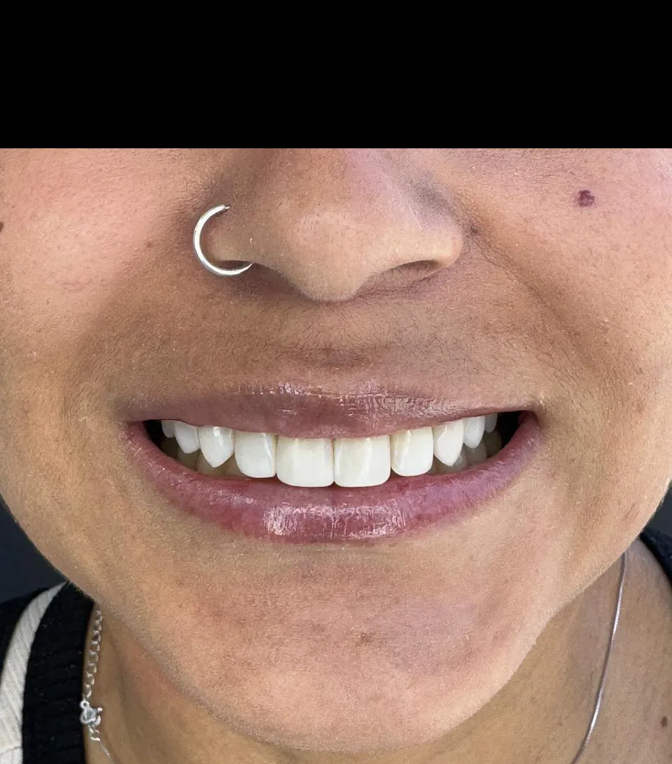 caso-de-diseño-de-sonrisa-despues-7