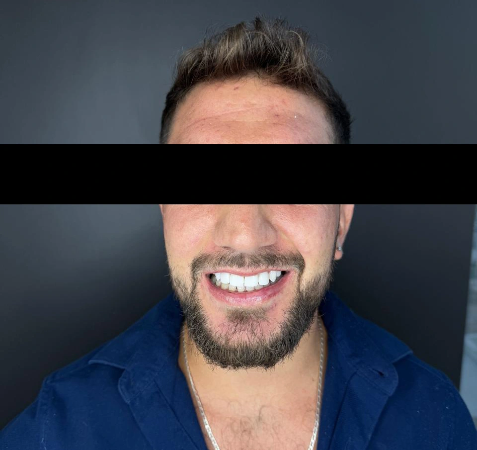 caso-de-diseño-de-sonrisa-despues-5