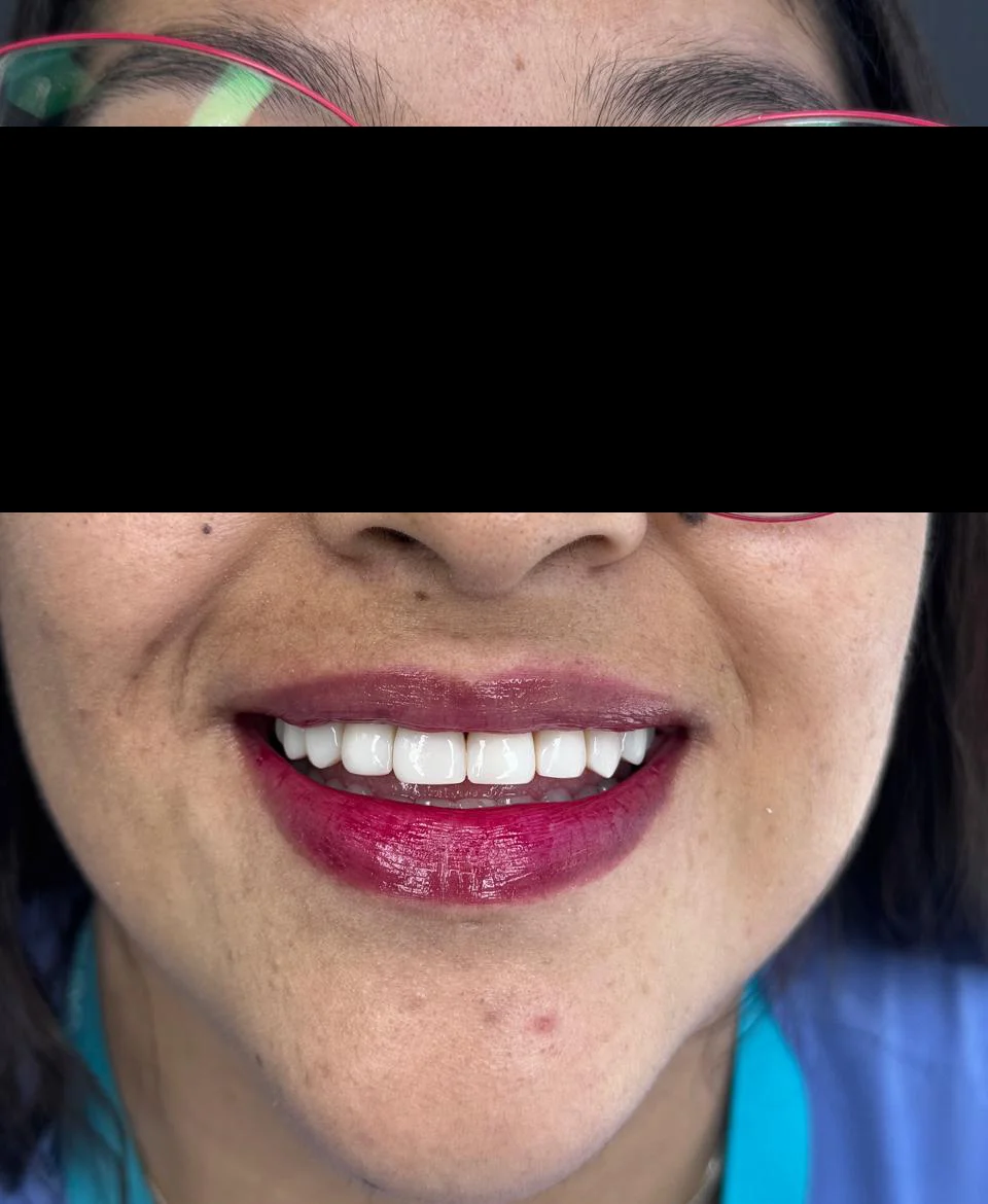 caso-de-diseño-de-sonrisa-despues-6