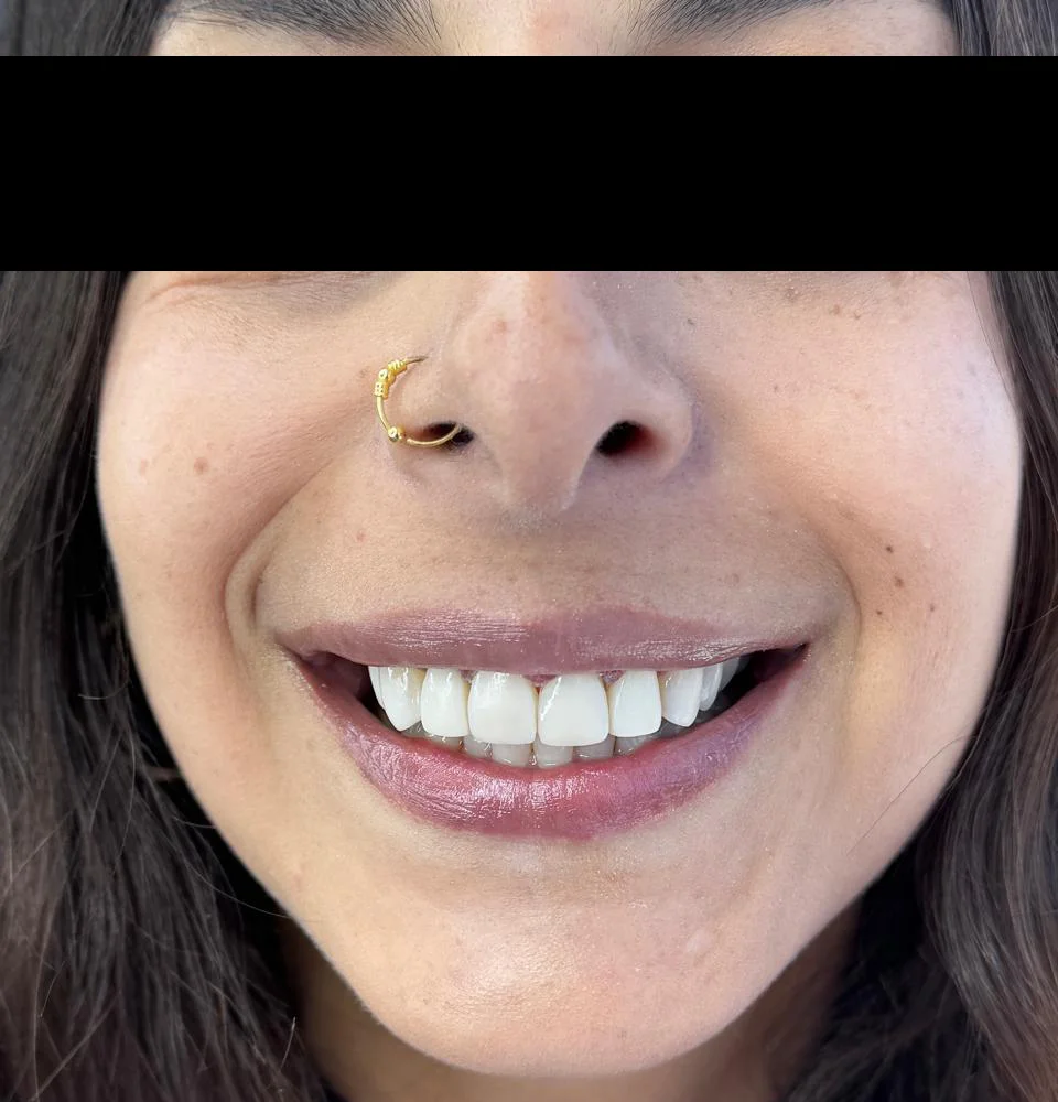 caso-de-diseño-de-sonrisa-despues-3