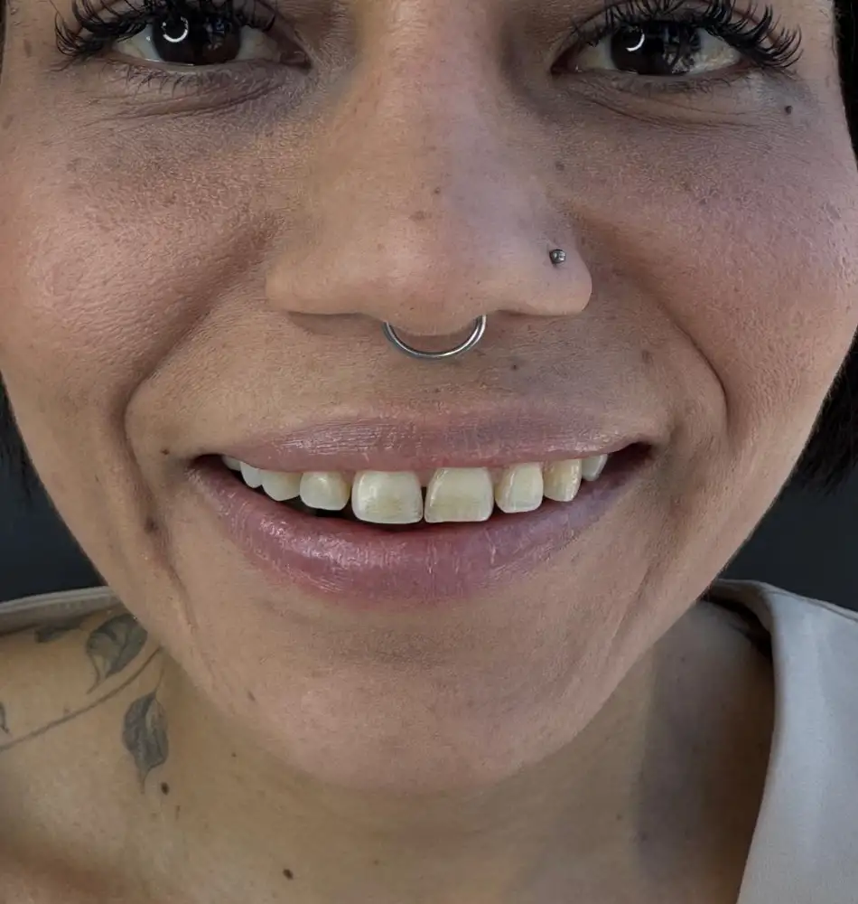 antes-del-diseño-de-sonrisa