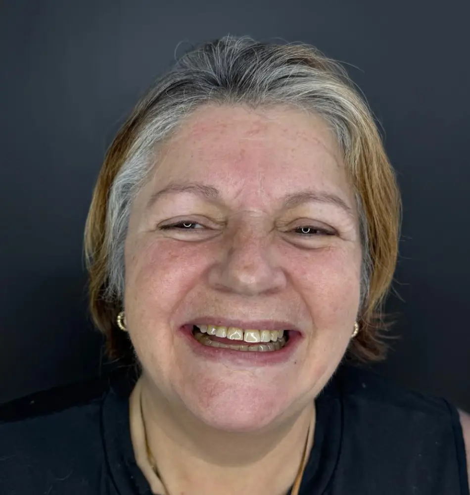 caso-de-diseño-de-sonrisa-antes-1