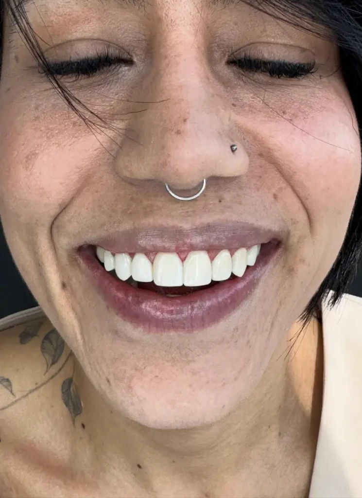 Diseño-de-sonrisa