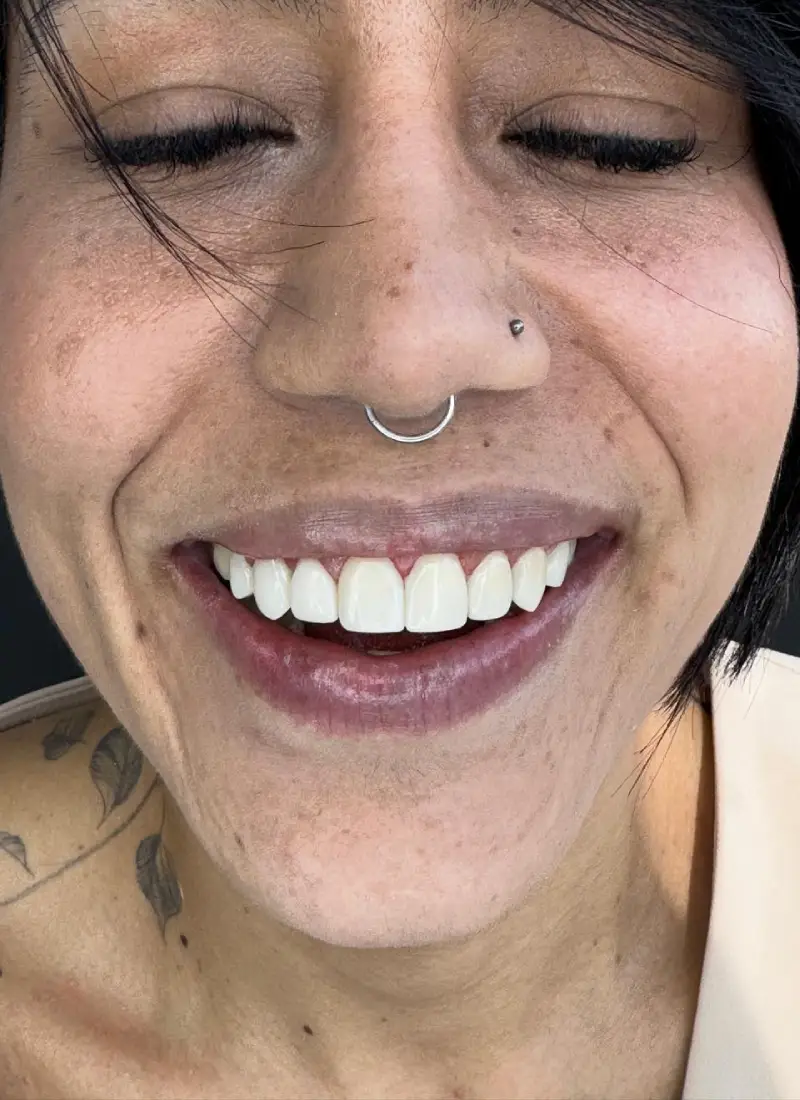 caso-de-diseño-de-sonrisa-despues-2