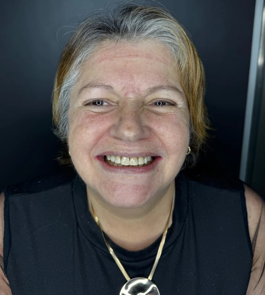 caso-de-diseño-de-sonrisa-despues-1